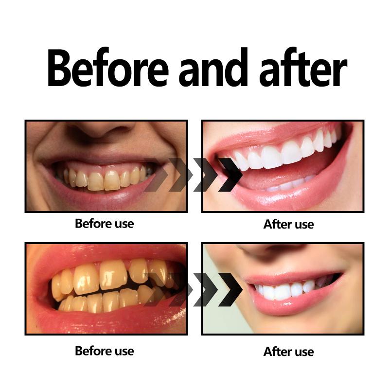 ผงฟอกสีฟัน ผงถ่าน/ผงฟอกสีฟันเบ - Teeth Whitening Baking Soda บทวิจารณ์และราคา