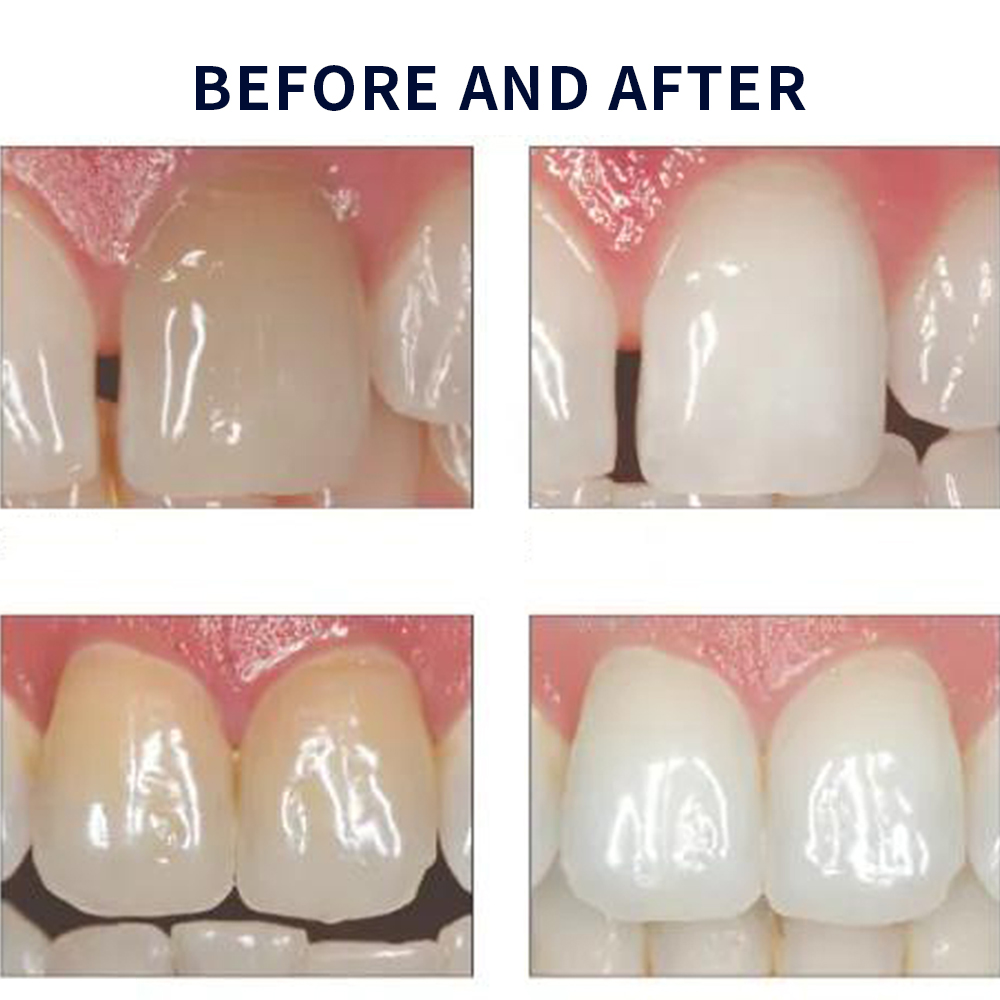 20% pF 20 16ชุดเจล8x1.2มล. ชุด - Teeth Whitening Bleaching Kit บทวิจารณ์และราคา