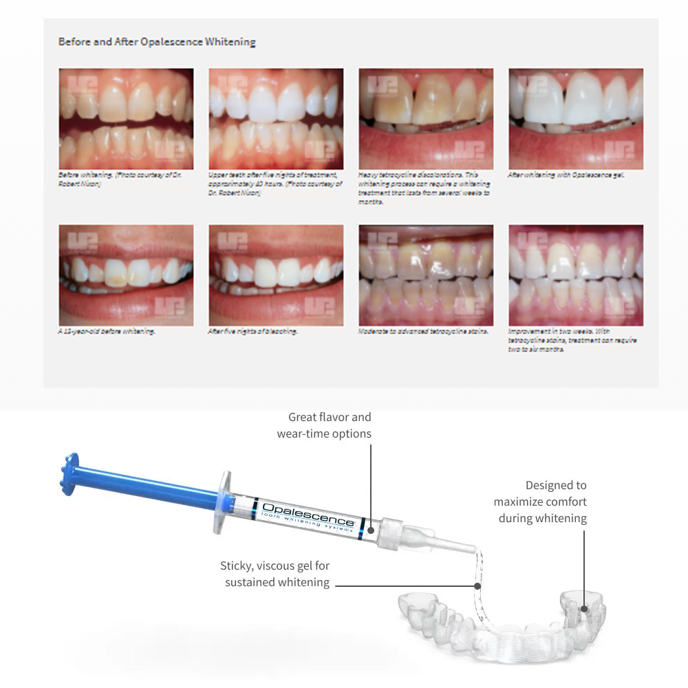 20% pF 20 16ชุดเจล8x1.2มล. ชุด - Teeth Whitening Bleaching Kit บทวิจารณ์และราคา