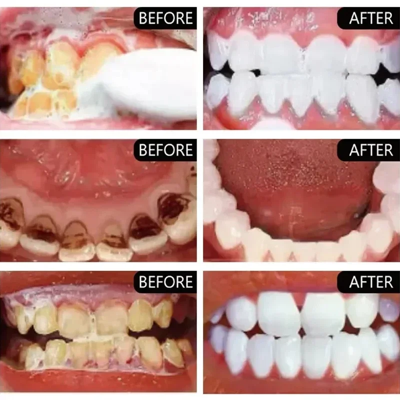 Fast ลบคราบควันยาสีฟันลบคราบจุ - Teeth Whitening Fast บทวิจารณ์และราคา