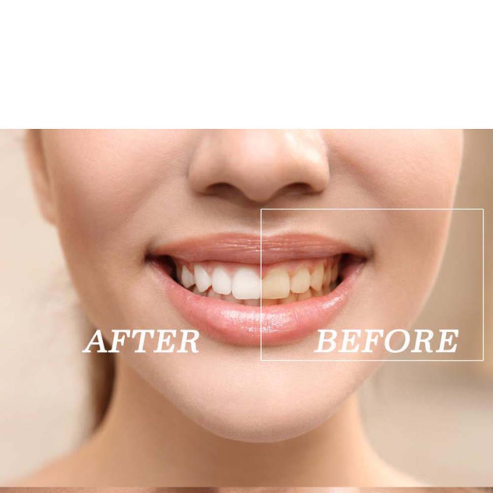 ชุดเจลฟอกสีฟอกสีฟันเปอร์ออกไซด - Teeth Whitening Bleaching Kit บทวิจารณ์และราคา