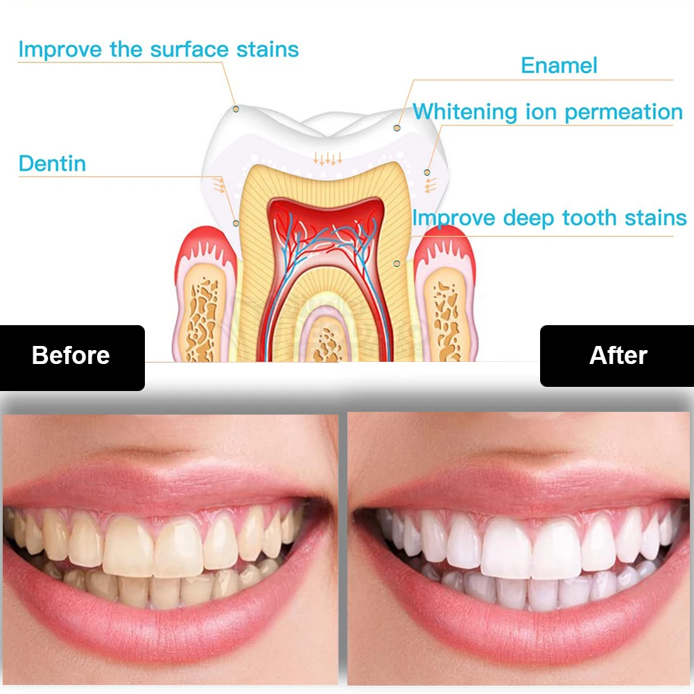 ทันตกรรมชุดฟอกสีฟัน Mini 16 LE - Teeth Whitening From Home บทวิจารณ์และราคา